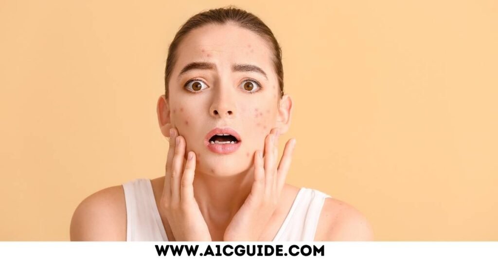 can diabetes cause acne